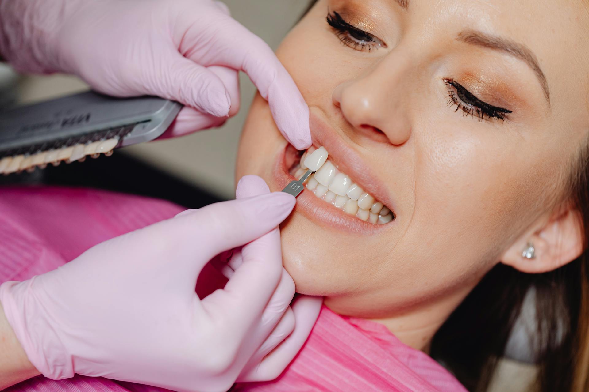 The Aesthetic and Protective Benefits of Veneers in London